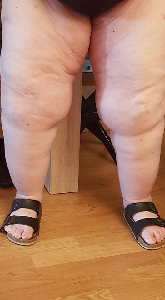 Lipödem Stadium lll: Suche Arzt für Liposuction